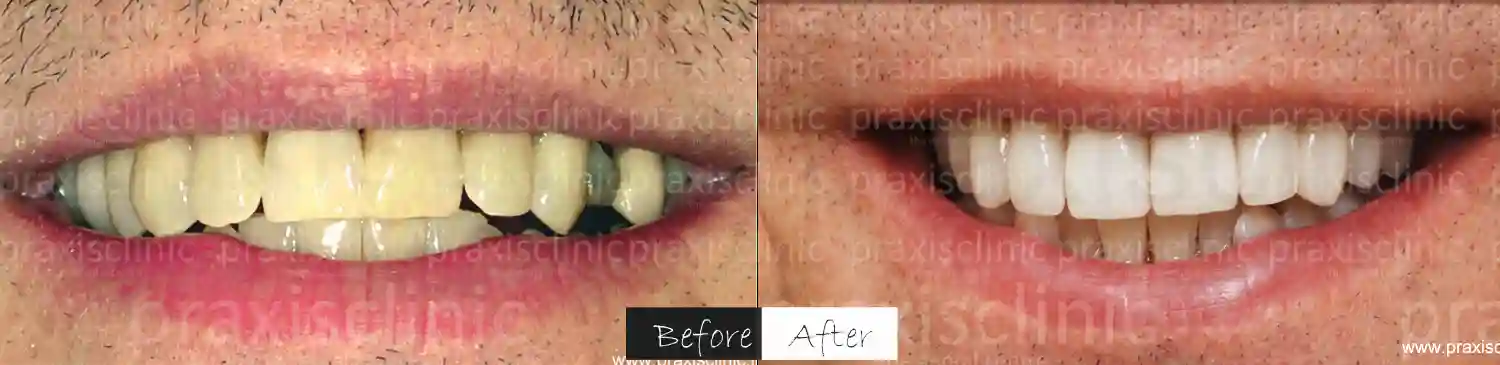 Before and After results of Digital Smile Design and Makeover at Praxis Dental clinic in Mumbai